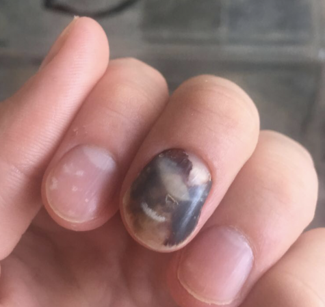 Losing a fingernail … patience and regrowth
