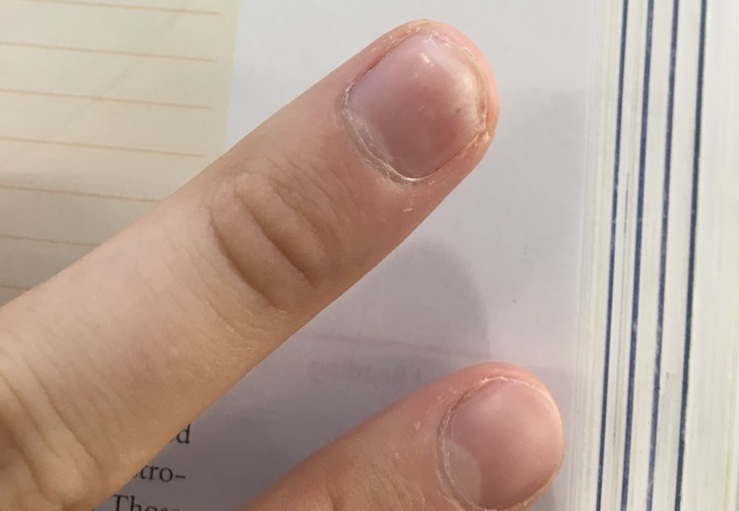 What To Do When You Lose A Whole Nail